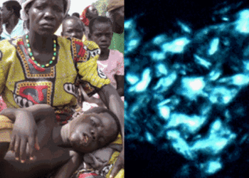 Over 1,700 estimated to be suffering from nodding disease in Acholi