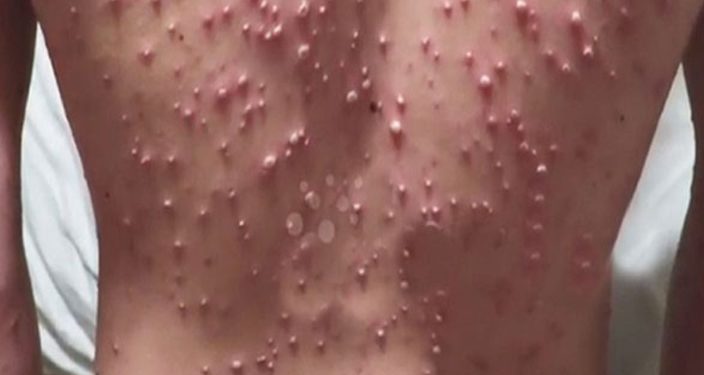 Measles outbreak hits Kibuku district, 5 cases registered
