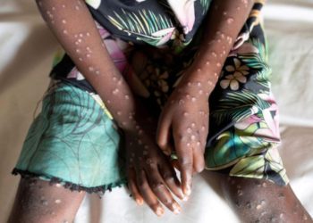 WHO raises Mpox response to highest levels in Africa