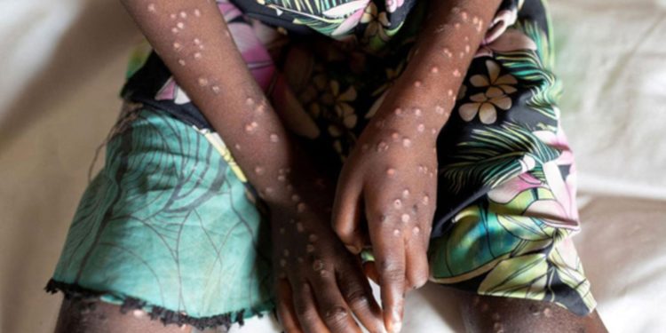 WHO raises Mpox response to highest levels in Africa