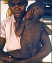 Measles1